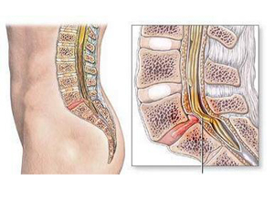 椎管发育性狭窄程度,测量时先找出椎管后界,在腰椎侧位片因与横突重叠