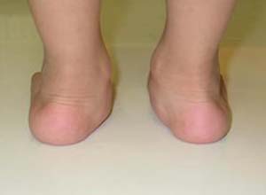 足外翻足外翻又叫外翻仰伸足,是指儿童足跟轴向外偏斜,是足部常见畸形