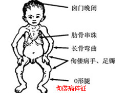 佝偻病图集