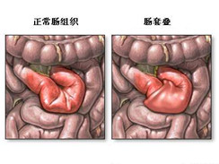 肠套叠