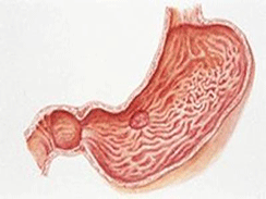 胃溃疡图集