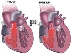 先天性心脏病