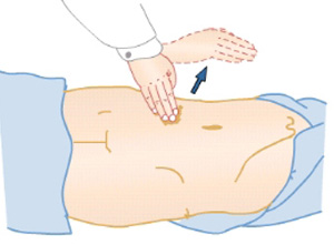 腹部有局部或广泛触痛、反跳痛