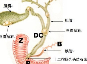 肝内管梗阻