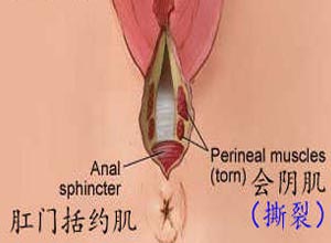 肛门外括约肌断裂