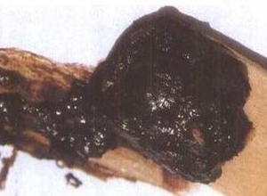 肠癌的早期黑便图片图片