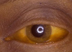 巩膜黄染早期图片