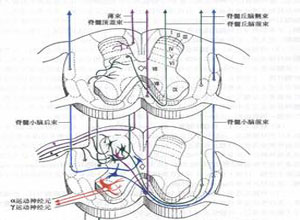 脊髓内胶质增生