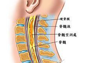 脊髓内空洞形成