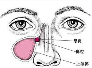 间歇性鼻阻塞