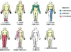 节段性分离性感觉障碍