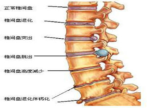 颈椎间盘突出