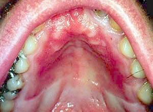 口腔念珠菌感染