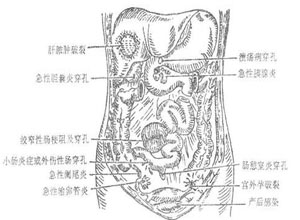 腹腔脂膜炎图片