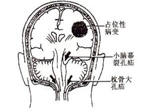 小脑占位图片