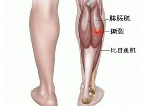 腓肠肌强直收缩并有疼痛