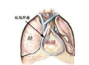 气管间隙形成肿块