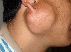 腮腺无痛性肿块基底细胞腺瘤表现为腮腺无痛性肿块