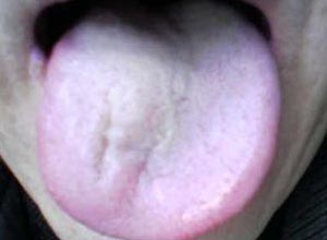 舌肌萎缩