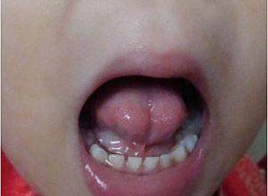 舌位于口腔底不能外伸