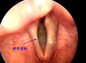 声带萎缩