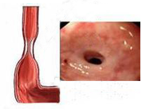 食管腔狭窄