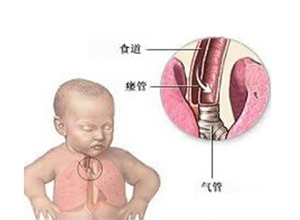 食物下咽时颈部有气过水声感