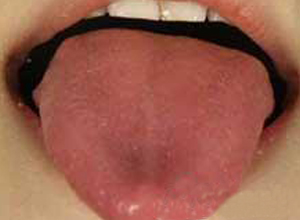 痛性红舌