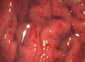 胃镜下表现出广泛黏膜红斑