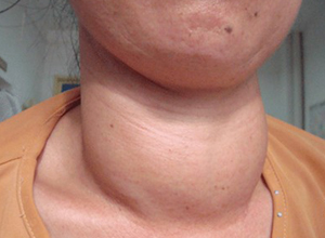 甲状腺结节图片早期图片