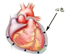 心包压塞