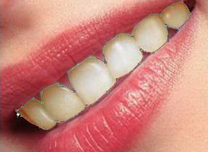 牙齿颈部黄斑