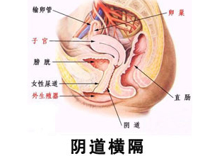 阴道横隔