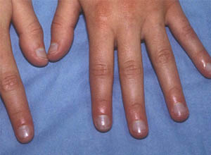 指甲呈现青紫色手指甲青紫色应该是末梢循环不良,可能是雷诺综合征的